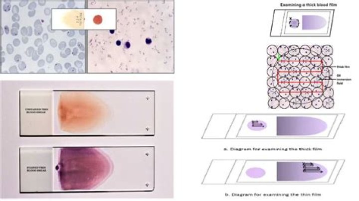 Why is it important not to use thick or dense bacterial smears?